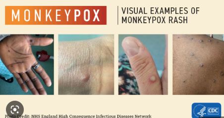 Monkey Pox - My Pfizer Vaccine Injury Update - October 31, 2022