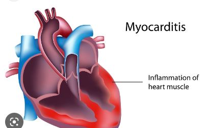 Myocarditis - My Pfizer Vaccine Injury Update - October 15, 2022